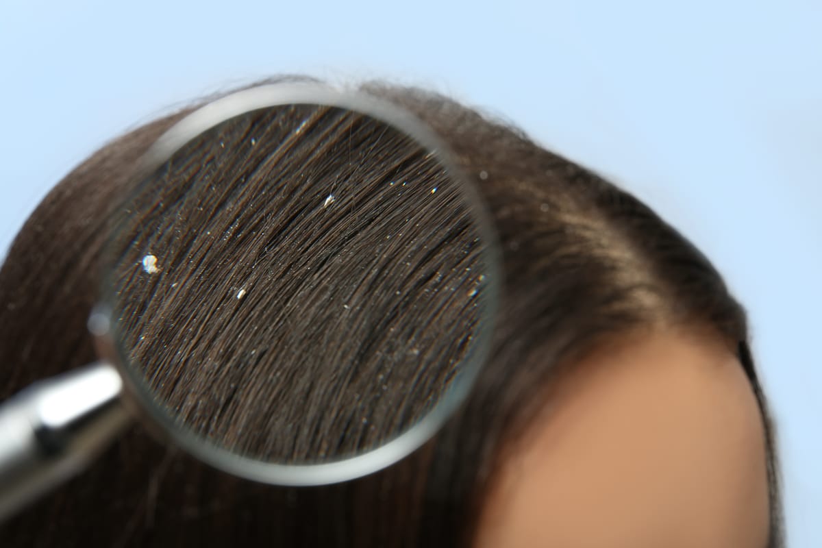 Stop Scrubbing Your Flakes: The 2-Minute Test to Tell if Your Scalp is Dry or Truly Dandruff